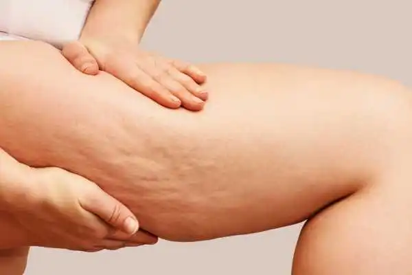Image of woman showing leg with cellulite Portobello