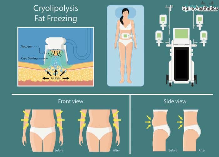 Image of diet and fat freezing combined for best results for Spire Aesthetics Portobello