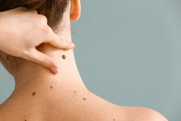 skin blemish removal Portobello treatment